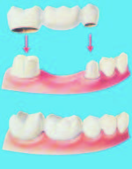 Bridge: A dental restoration