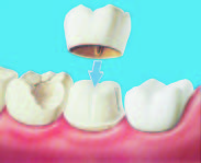 Crown: A dental restoration