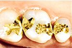 Gold Inlays in dental crown