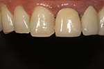Case Study - IPS E.MAX Dental Crown - Before