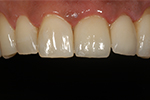 Case Study - IPS E.MAX Dental Crown - After