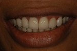 Dental Crown case study
