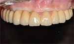 Dental Case Study - Full Arch Screw Retained PFM PLUS - Finished PFM Plus