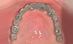 Dental Case Study - Full Arch Screw Retained PFM PLUS - Framework Try in