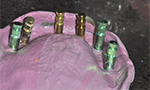 Dental Case Study - Full Arch Screw Retained PFM PLUS - Open Tray Impression