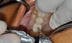 Dental Case Study - Full Arch Screw Retained PFM PLUS - Surgery