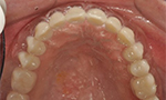 Dental Case Study - Full Arch Screw Retained PFM PLUS - Vacuum formed Surgical Stent