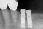 Dental implant prostheses