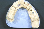 Ball retained  dental implant