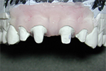 Dental Case Presentation - Working model after Preps in mouth