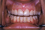 After Dental Treatment - Case Study
