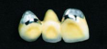 Dental restoration - Porcelain Fused to Metal