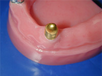 Electroformed secondary crown