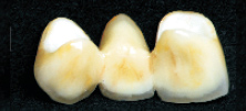 Dental restoration - Czar PFZ - Veneered Zirconia